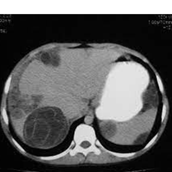 hydatid serology test